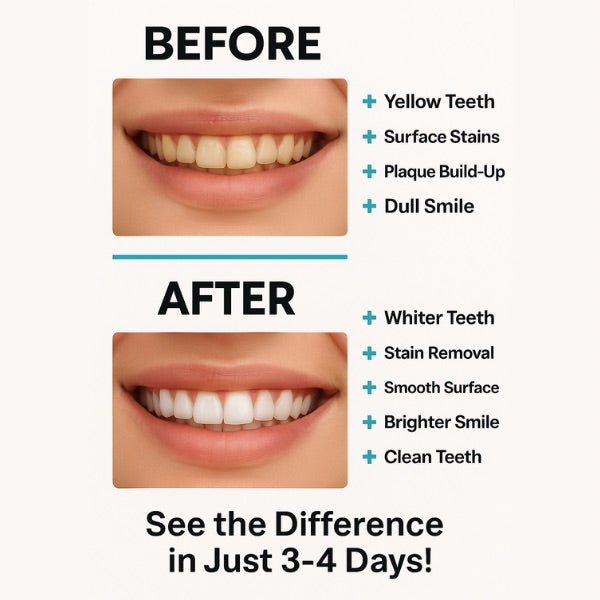 Carbon White – Teeth Whitening Strips (28) – No Peroxide, Sensitive Safe, Fast Results